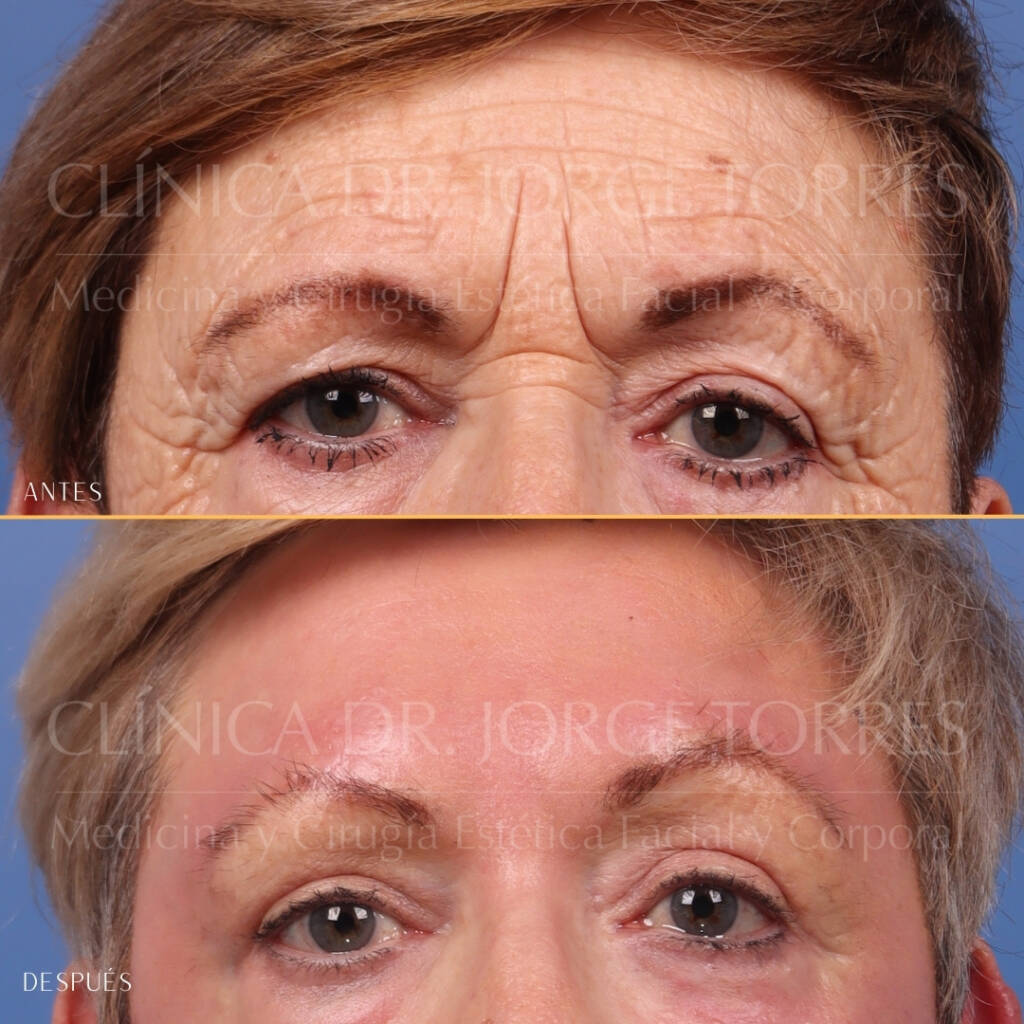 16521-MRGN-10-Frontal-periocular