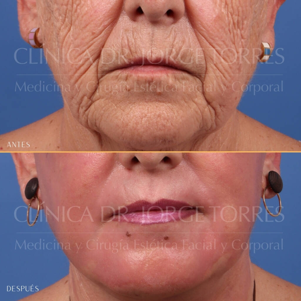 16521-MRGN-11-Frontal-perioral