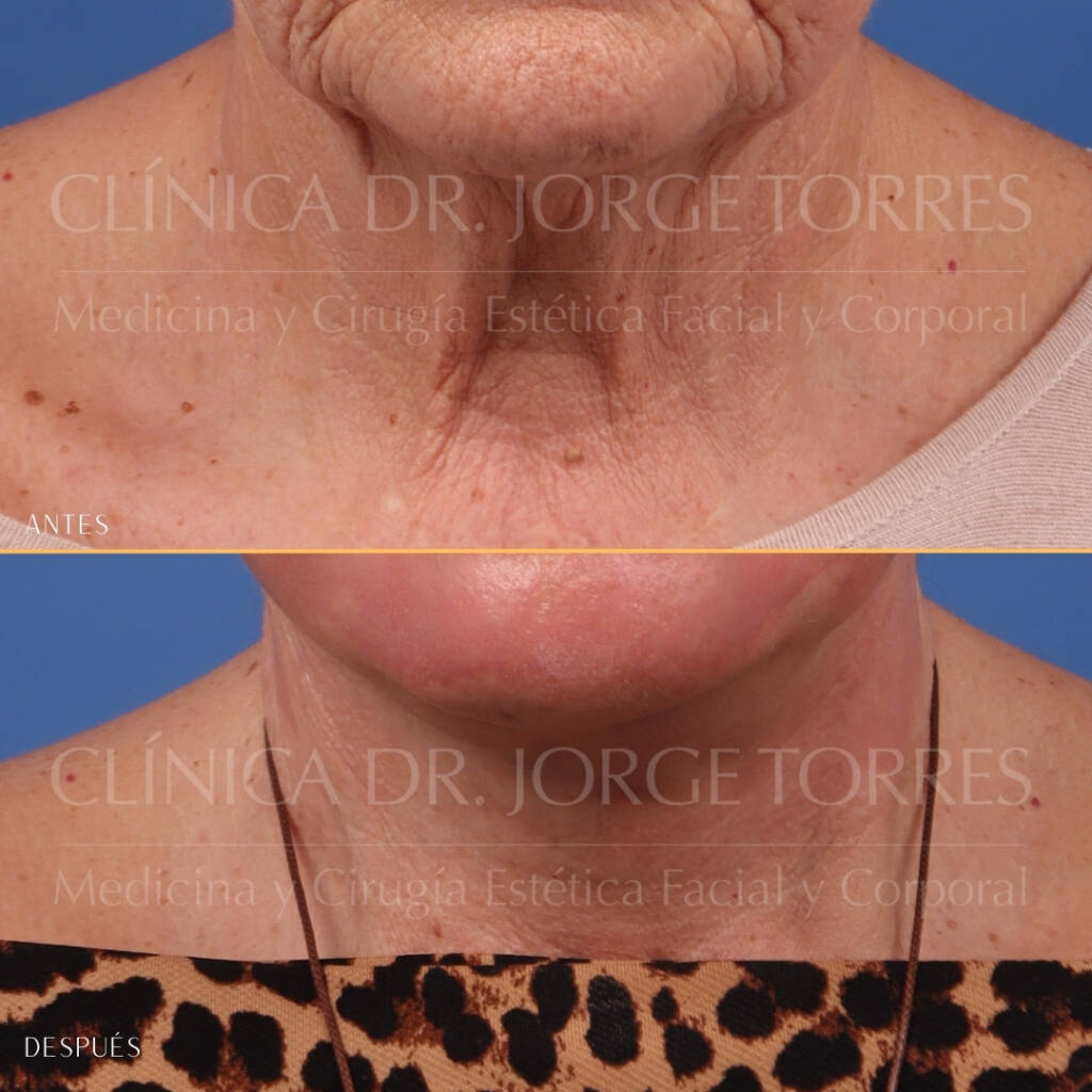16521-MRGN-12-Frontal-cuello