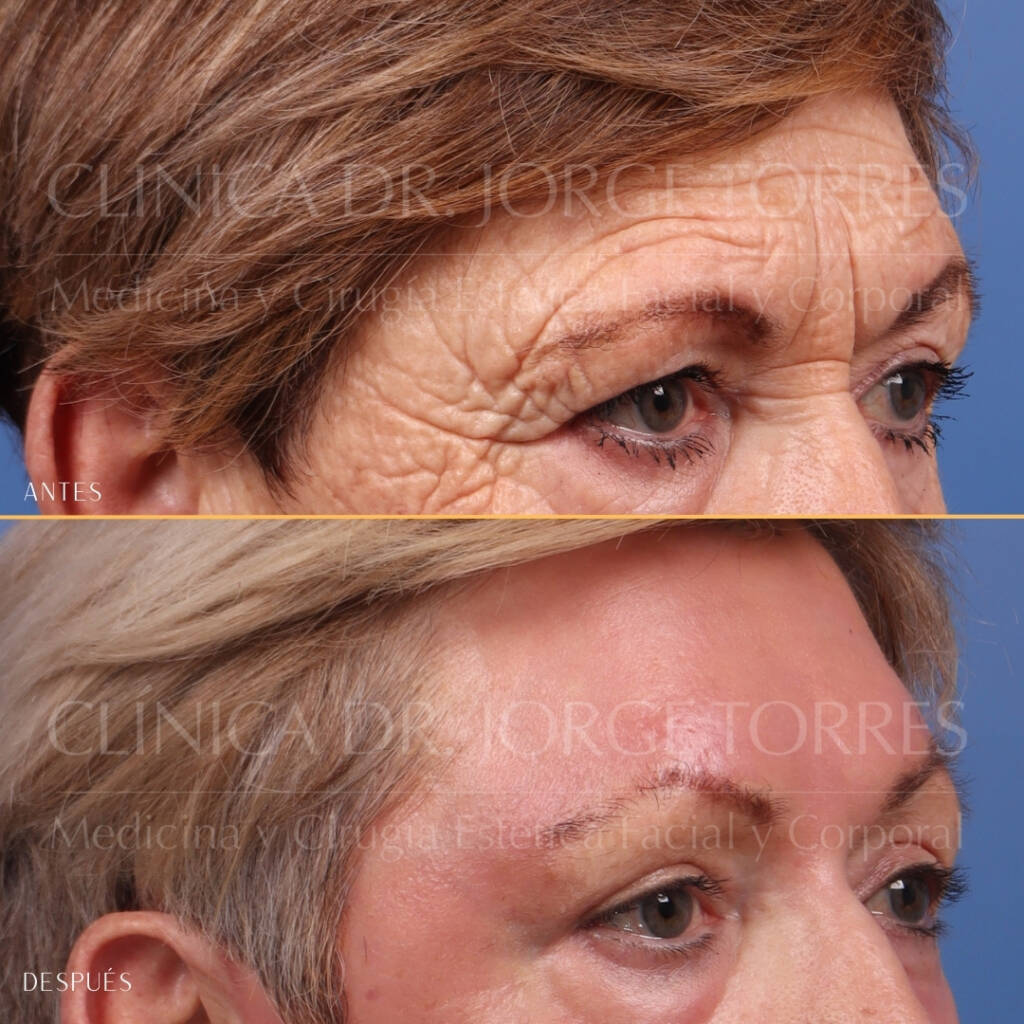 16521-MRGN-13-Oblicua-derecha-periocular