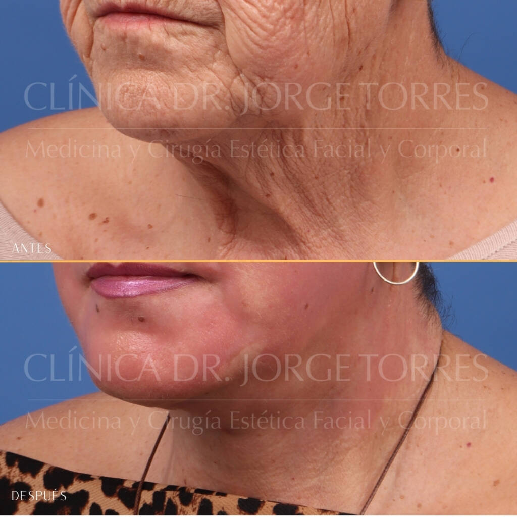 16521-MRGN-19-Oblicua-izquierda-cuello