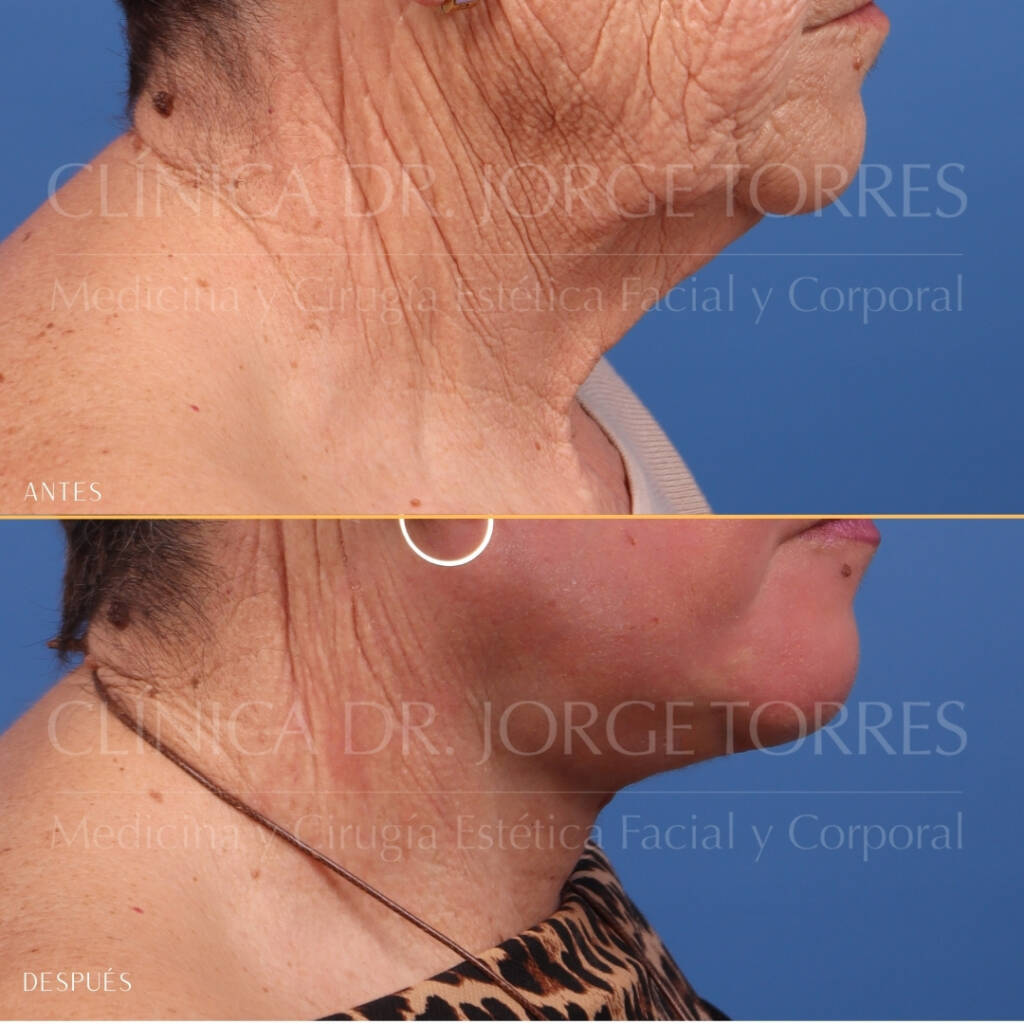 16521-MRGN-23-lateral-derecho-cuello
