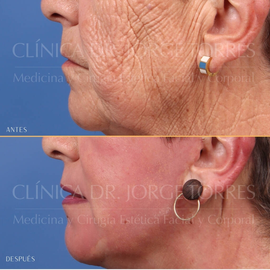 16521-MRGN-27-Lateral-izquierda-perioral
