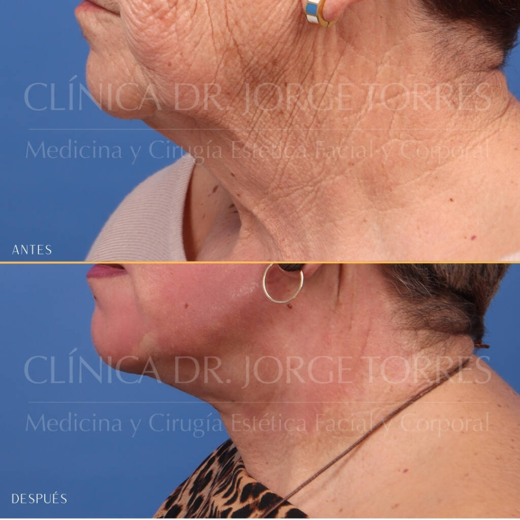 16521-MRGN-28-Lateral-izquierda-cuello