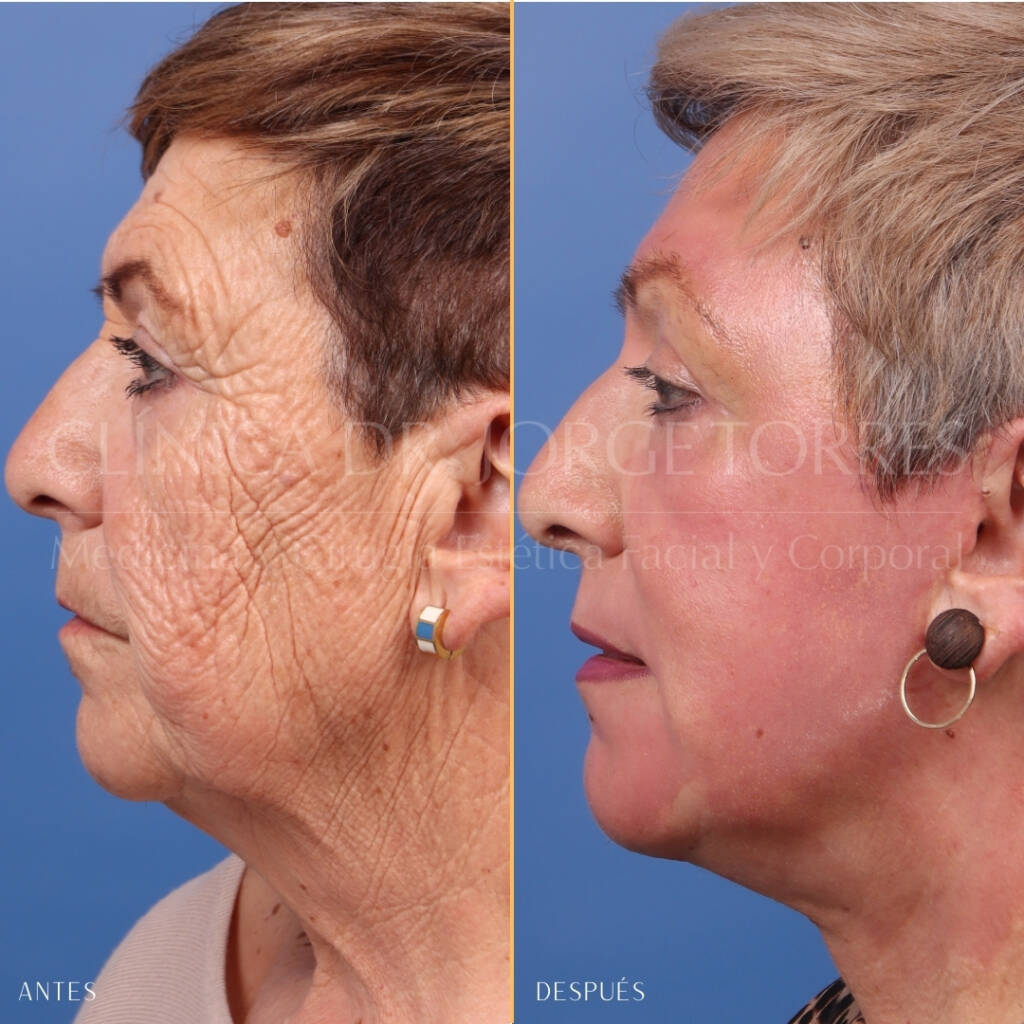 16521-MRGN-29-Lateral-izquierda-zoom-facial