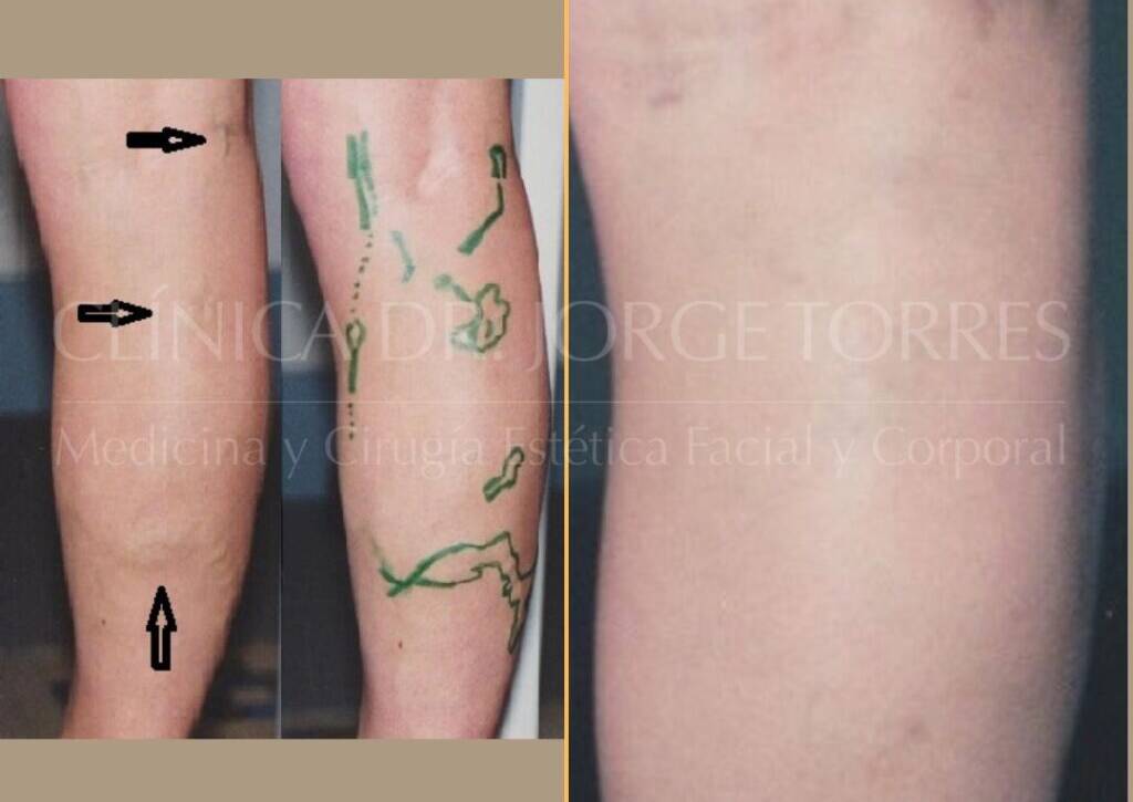 Varices_Cirugia-Venosa