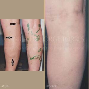 Varices_Cirugia-Venosa