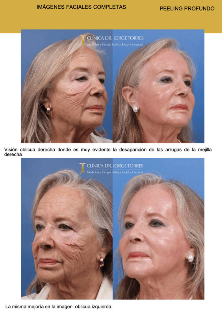 IMÁGENES FACIALES COMPLETAS PEELING PROFUNDO