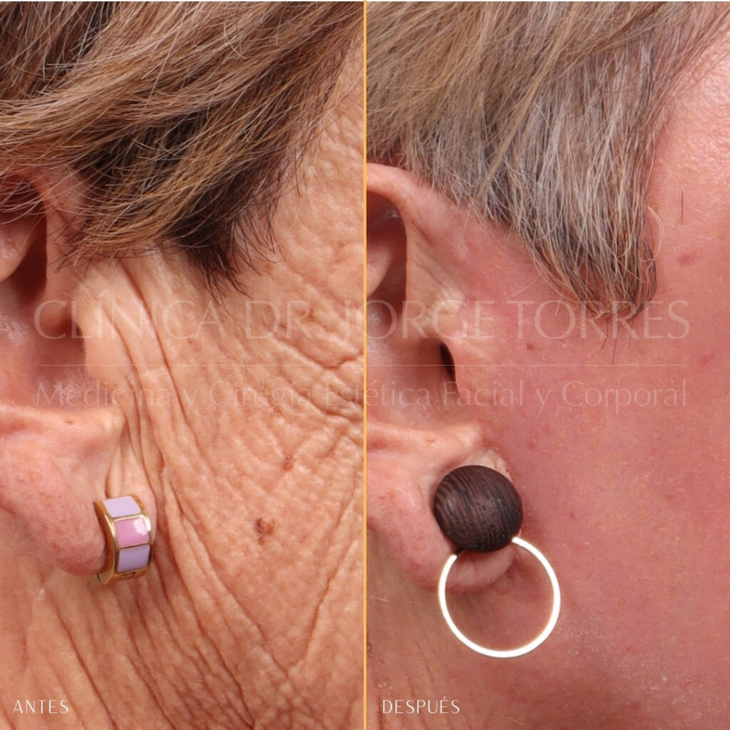 16521-MRGN-25-lat-dere-cicatrices-delante-oreja