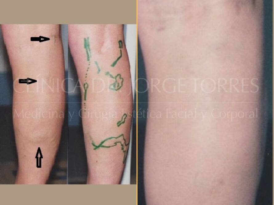 Varices_Cirugia-Venosa