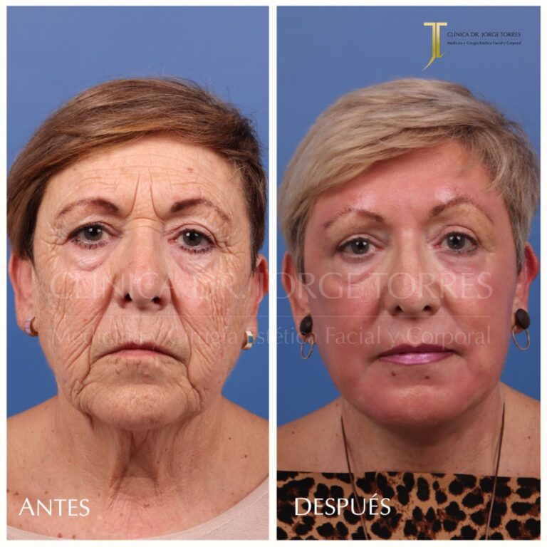 Peeling Profundo