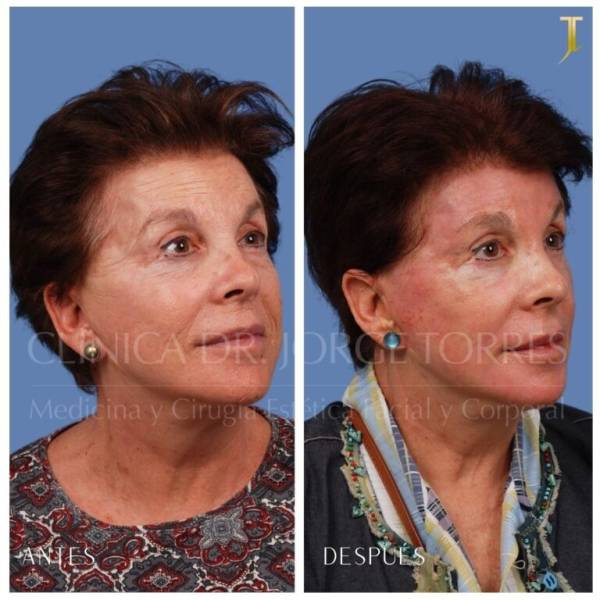 Peeling Profundo